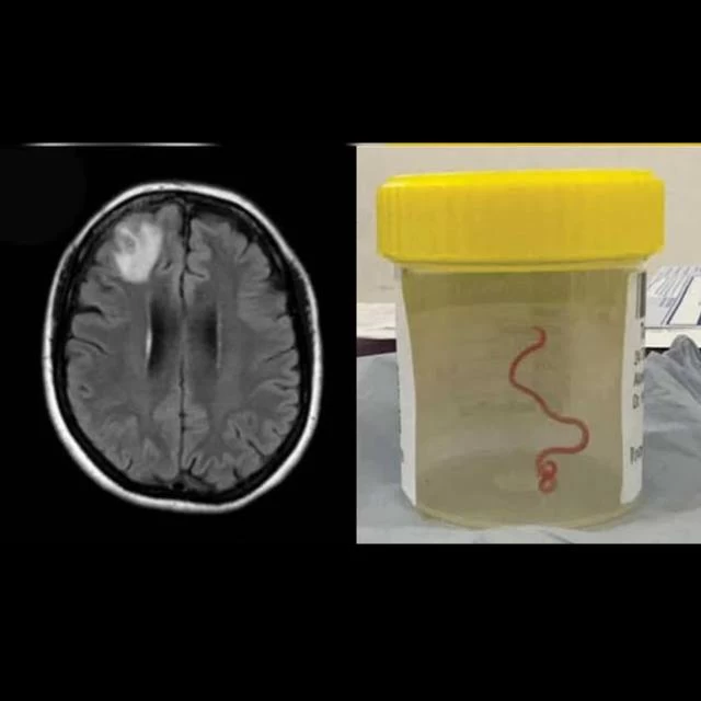 Live Parasitic Worm Found